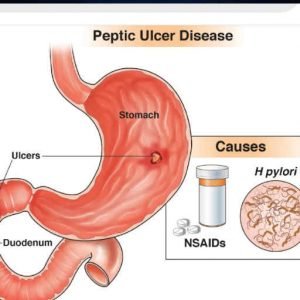 Maganin ulcer